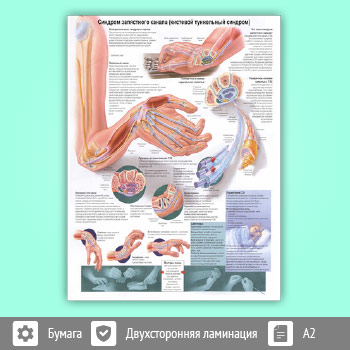 Плакат «Синдром запястного канала (кистевой туннельный синдром)» (ЗОЖ-24, 1 лист, A2)